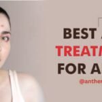 acne homemade remedies